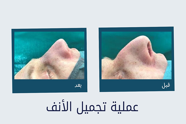 تجميل الانف